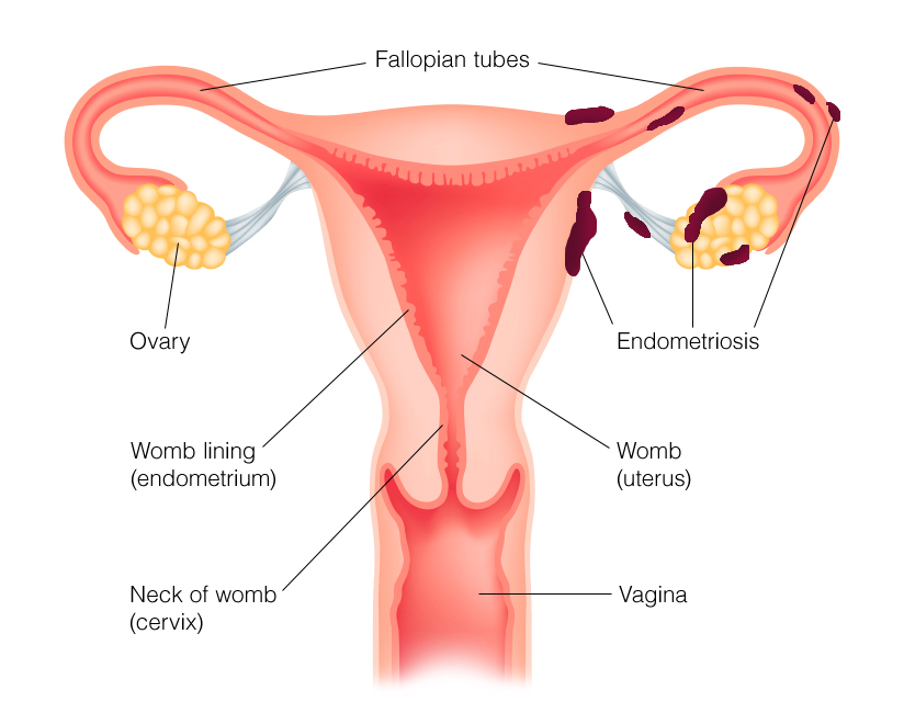 Common sites for endometriosis include the ovaries, fallopian tubes, vagina, cervix and Pouch of Douglas